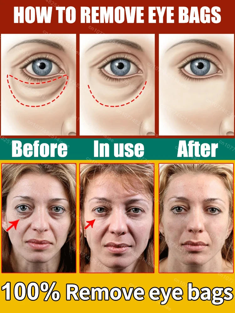 Instantly removes under eye bags,